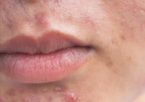 What Vitamins Can Cause Acne Breakouts?